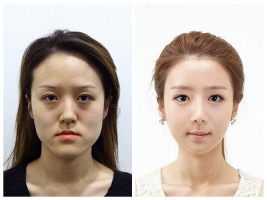 韩国双胞胎整容逆袭 经数次手术依然一模一样