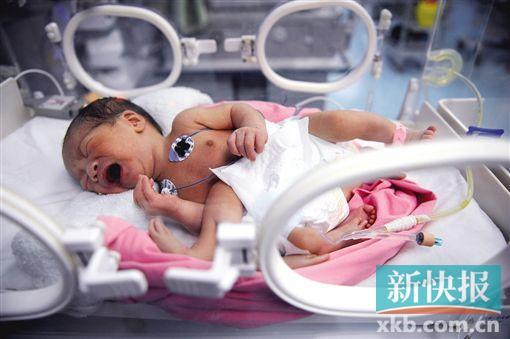 连体婴多长出一双手脚 医院成功切除多余手脚