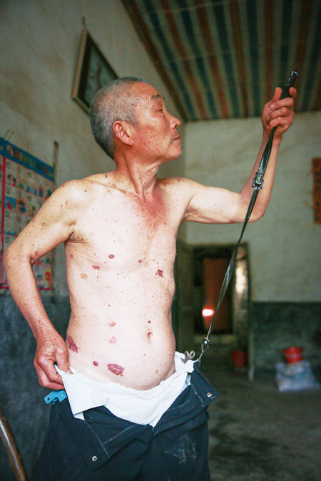 患皮肤癌的鹤山村村民龚兆元身上长出砷斑,裤子只能用皮带吊在肩上。本版摄/记者吴海浪