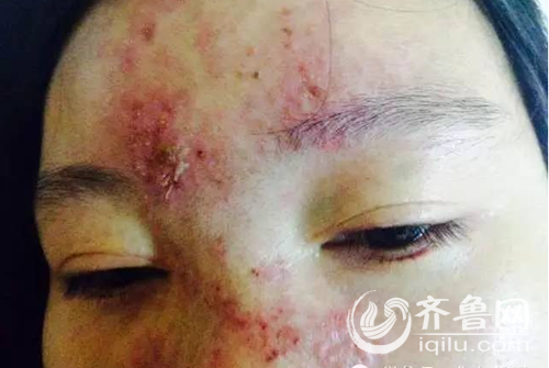 术后，孟女士的脸部出现溃烂（视频截图）