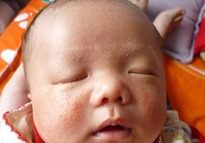 如何有效消除新生儿湿疹?