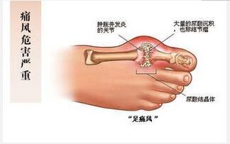 痛风病人吃什么好？ 饮食需合理搭配